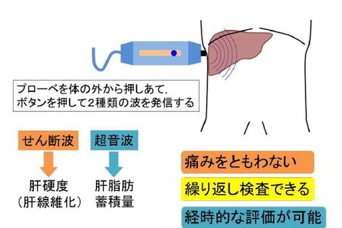 肥満児は肝硬変に高リスク…大阪市立大 画像