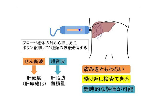 肥満児は肝硬変に高リスク…大阪市立大 画像