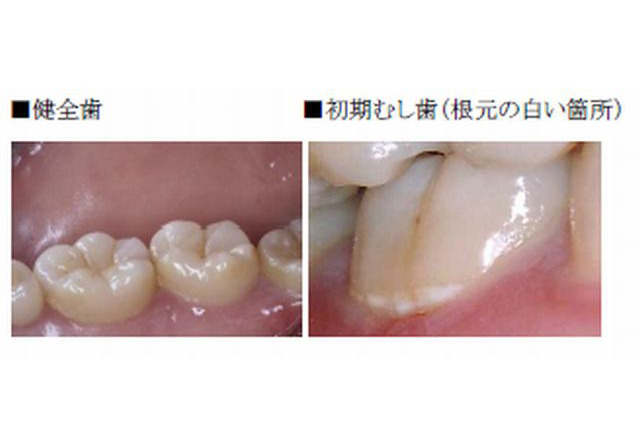 初期むし歯対策でむし歯予防を…子どものころからのケアが重要、江崎グリコ 画像