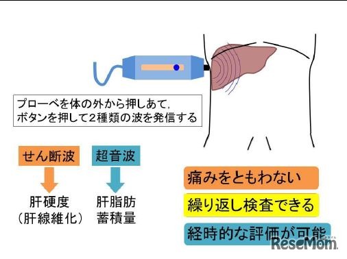 フィブロスキャン検査