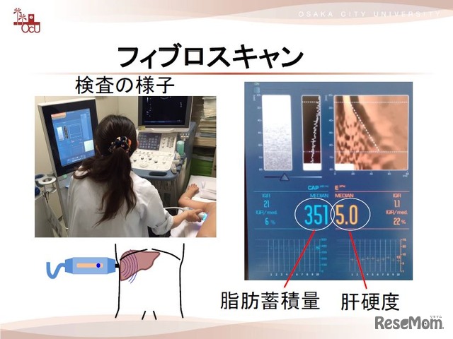 フィブロスキャン検査のようす