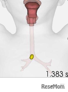 豆一粒が気管内に侵入するシミュレーション