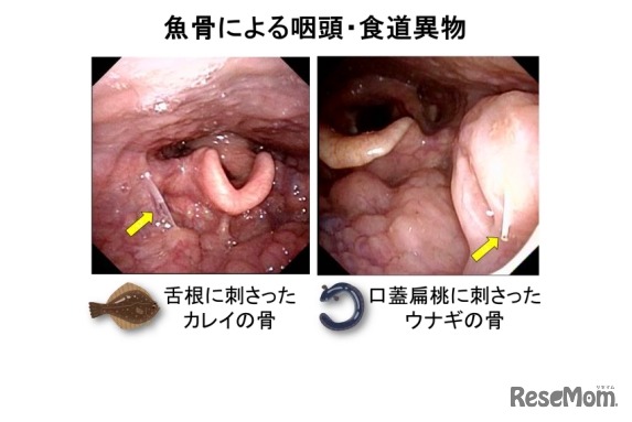 魚骨による咽頭・食道異物