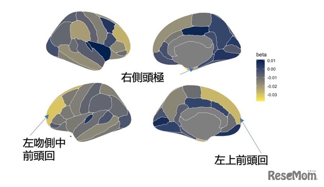 スクリーンタイムは右側頭極、左上前頭回、左吻側中前頭回などの脳領域で皮質厚の減少とも関連