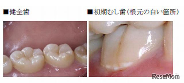 健康な歯と初期むし歯