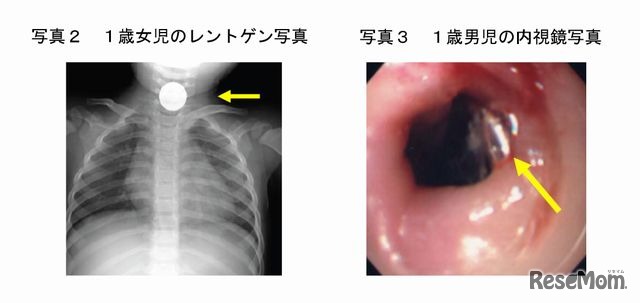 コイン形のリチウム電池が食道内に停滞して化学熱傷を起こした１歳女児のレントゲン写真（左）と１歳男児の内視鏡写真