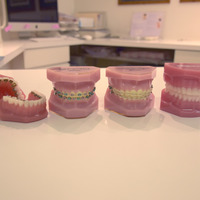 歯列矯正器具の種類